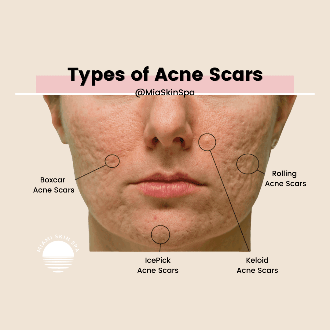 A womans face with each of the different types of acne scars highlighted and circled so the difference between each type of acne scar becomes clear